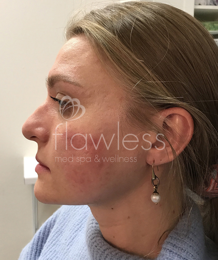 Jawline & Chin Filler Before & After Gallery - Patient 58193370 - Image 2