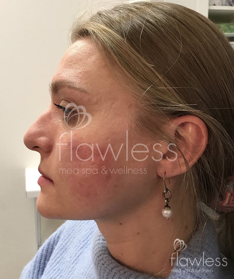Jawline & Chin Filler Before & After Gallery - Patient 58193370 - Image 2