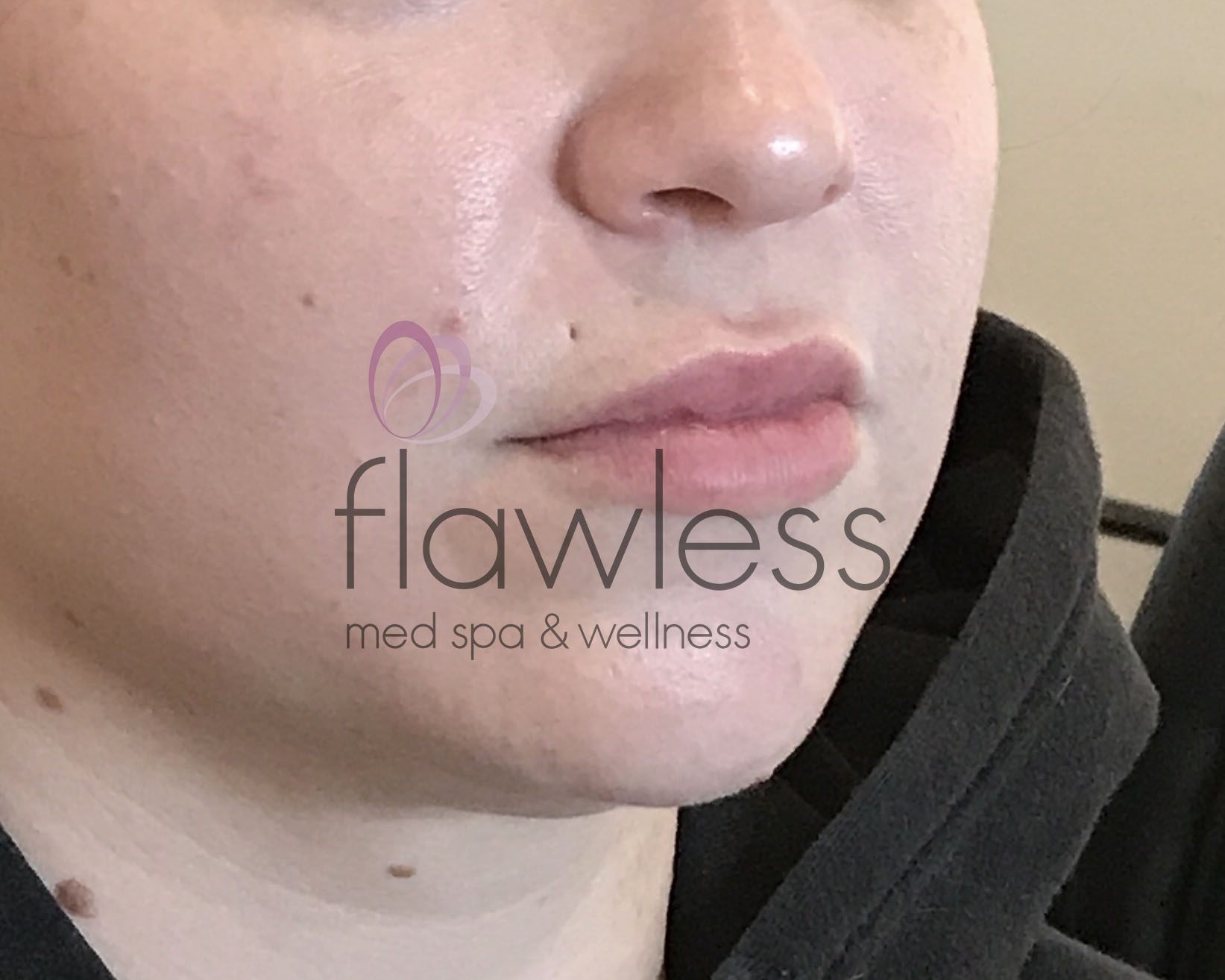 Lip Filler Before & After Gallery - Patient 58193373 - Image 1