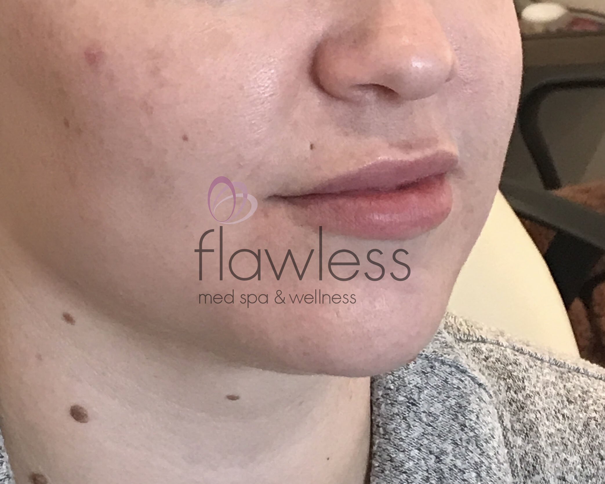 Lip Filler Before & After Gallery - Patient 58193373 - Image 2