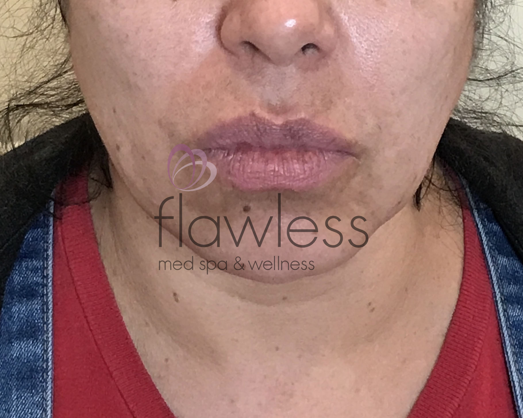 Lip Filler Before & After Gallery - Patient 58193374 - Image 1