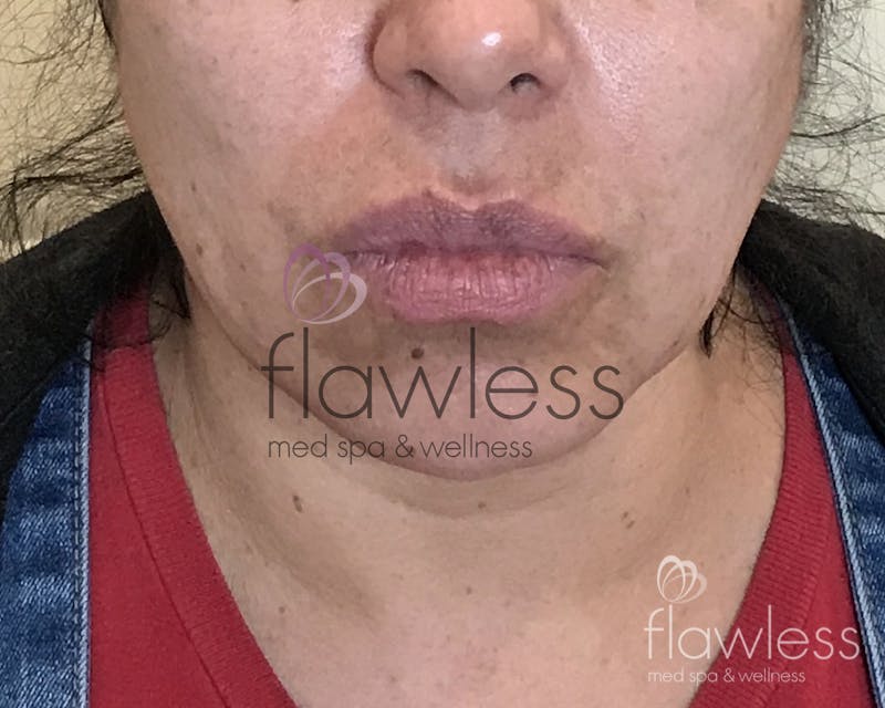 Lip Filler Before & After Gallery - Patient 58193374 - Image 1