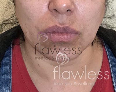 Lip Filler Before & After Gallery - Patient 58193374 - Image 1