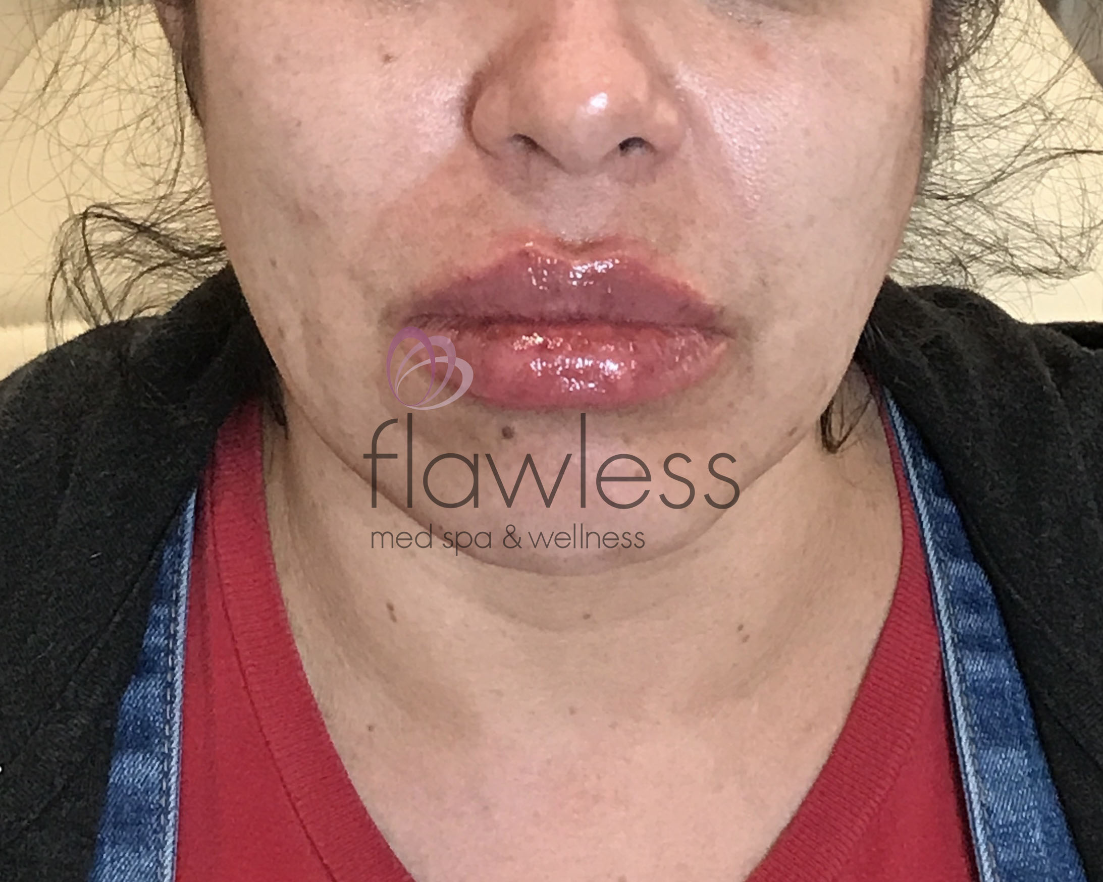 Lip Filler Before & After Gallery - Patient 58193374 - Image 2