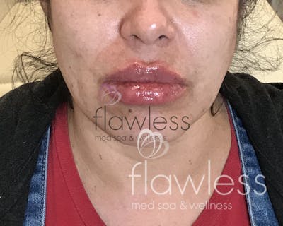 Lip Filler Before & After Gallery - Patient 58193374 - Image 2