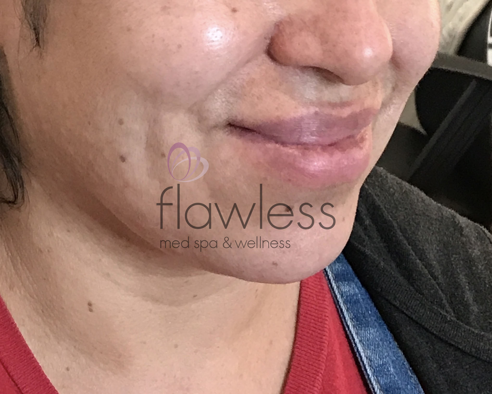 Lip Filler Before & After Gallery - Patient 58193375 - Image 1