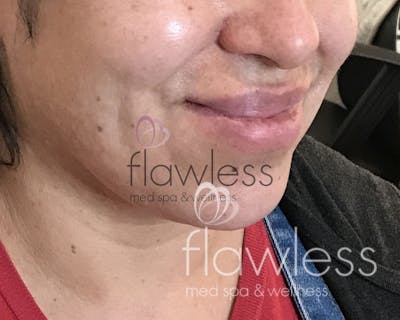 Lip Filler Before & After Gallery - Patient 58193375 - Image 1