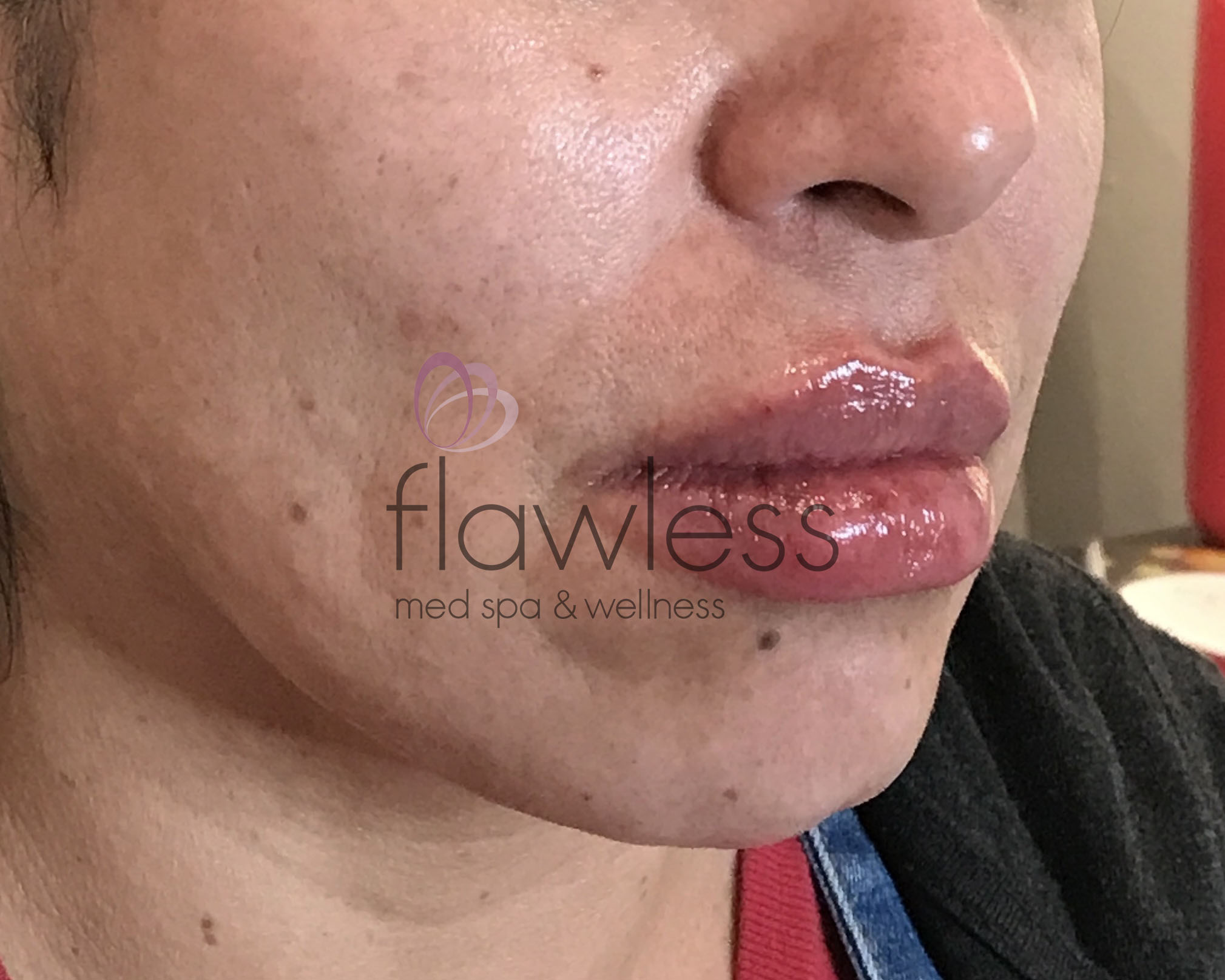 Lip Filler Before & After Gallery - Patient 58193375 - Image 2