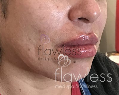 Lip Filler Before & After Gallery - Patient 58193375 - Image 2