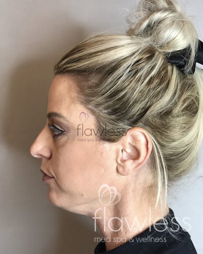 Kybella - Double Chin Before & After Gallery - Patient 58193377 - Image 1