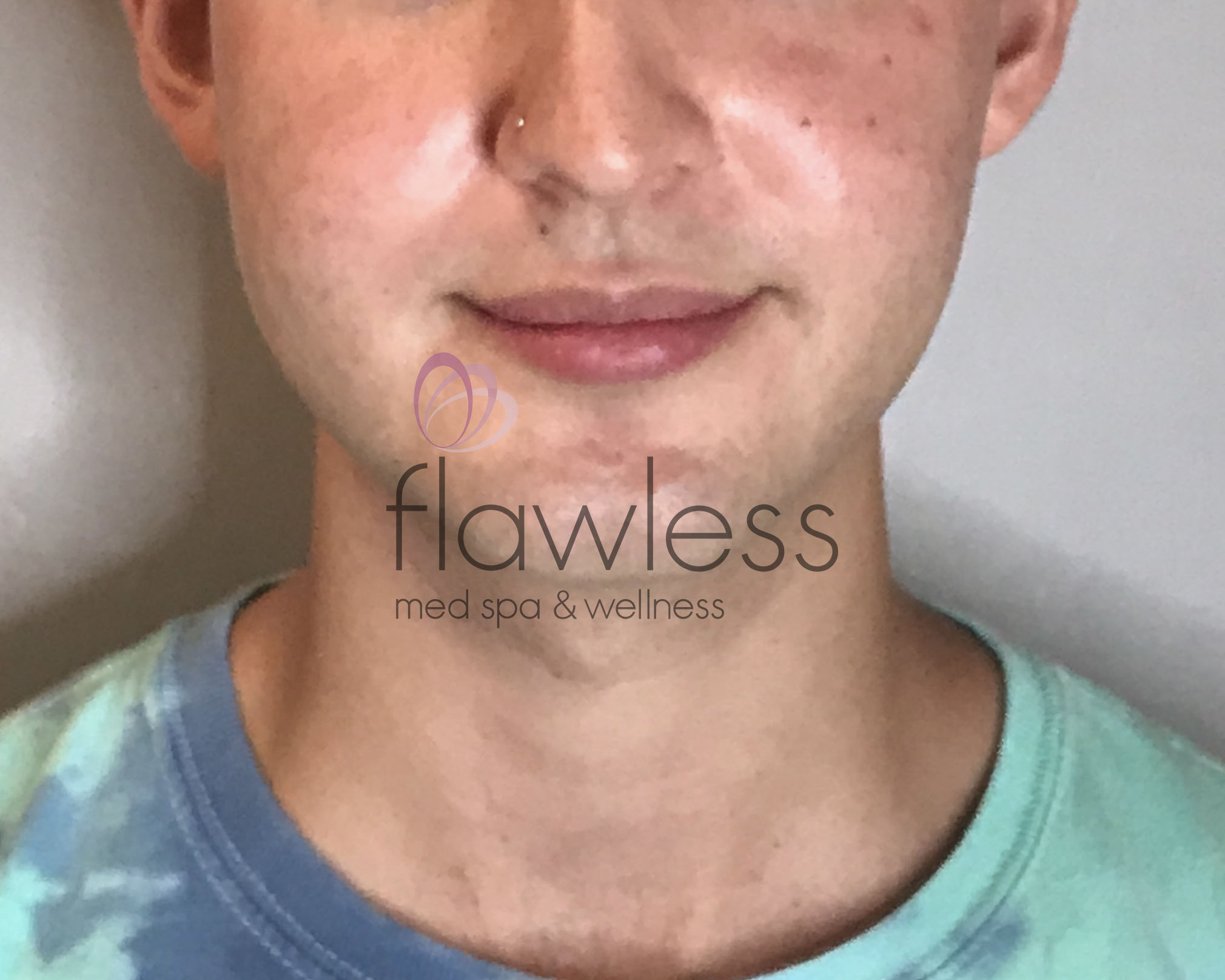 Lip Filler Before & After Gallery - Patient 58193376 - Image 1