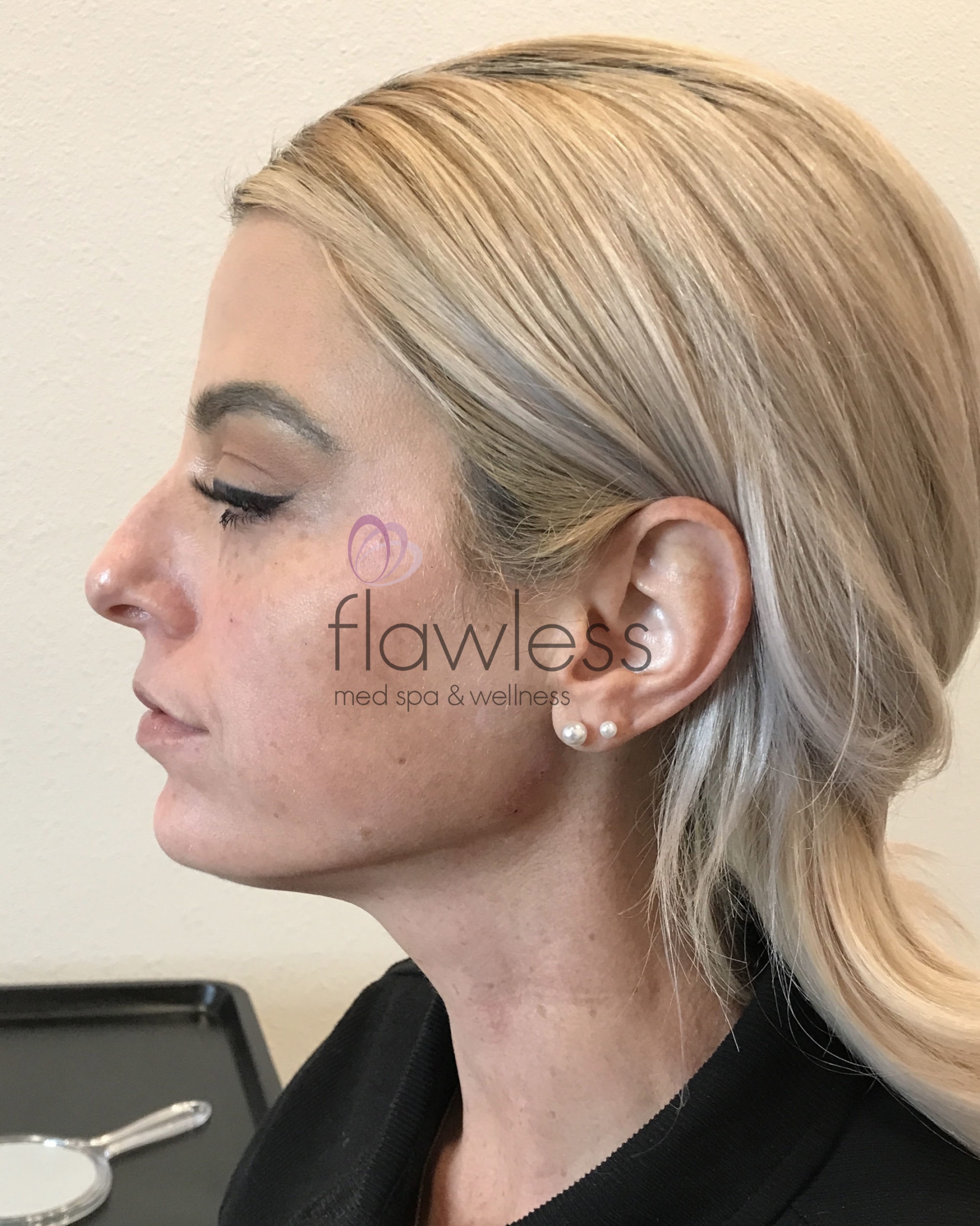 Kybella - Double Chin Before & After Gallery - Patient 58193377 - Image 2