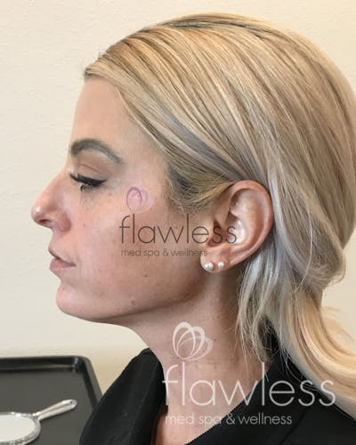 Kybella - Double Chin Before & After Gallery - Patient 58193377 - Image 2