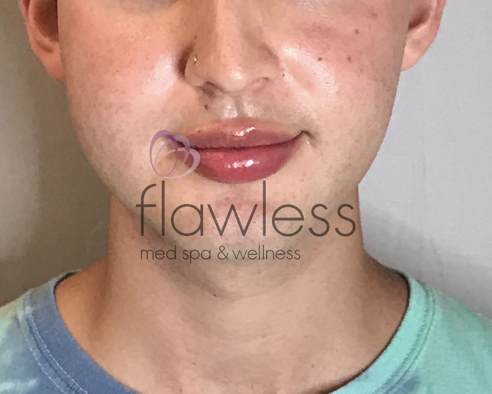 Lip Filler Before & After Gallery - Patient 58193376 - Image 2