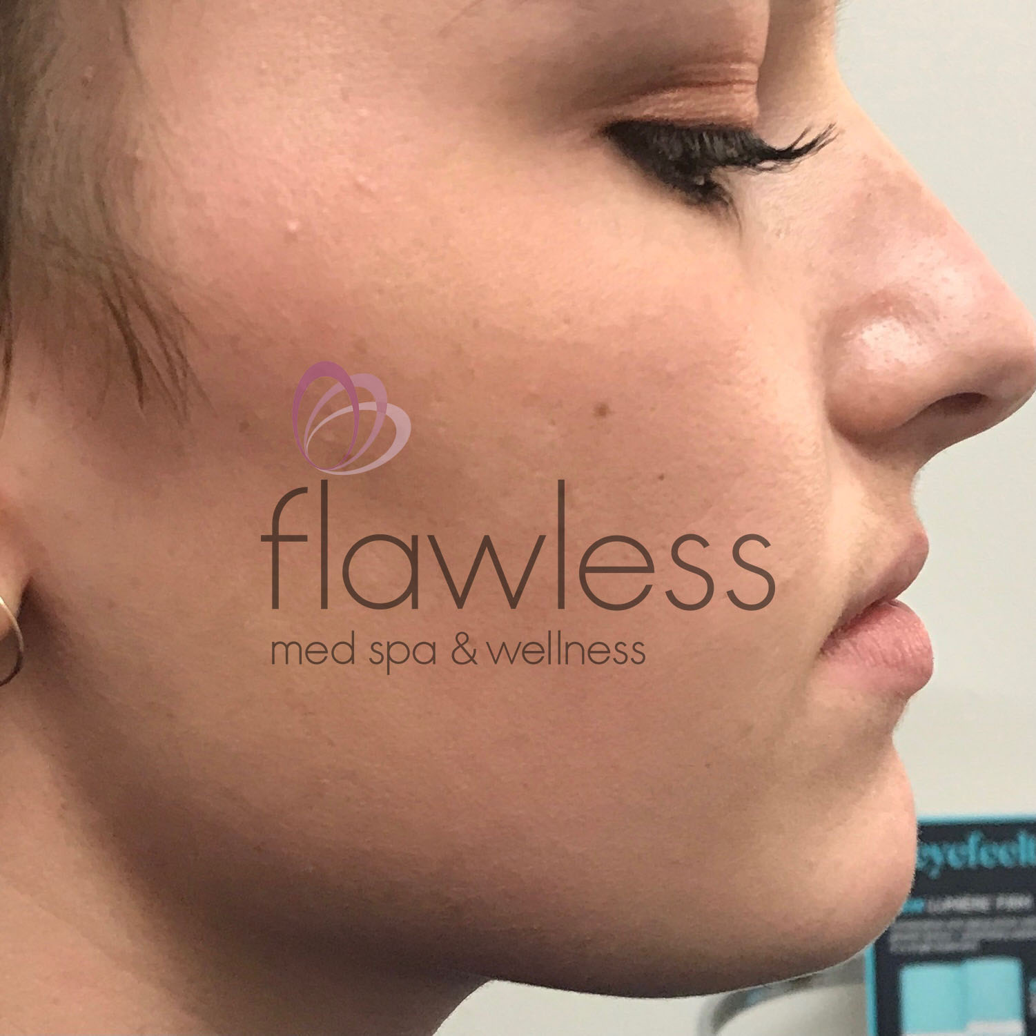 Lip Filler Before & After Gallery - Patient 58193379 - Image 1