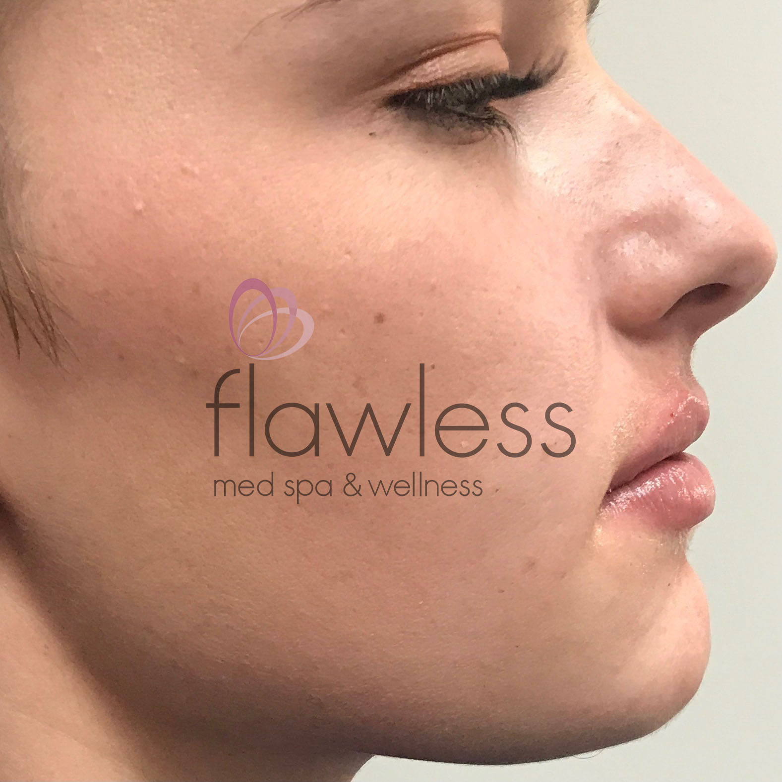 Lip Filler Before & After Gallery - Patient 58193379 - Image 2