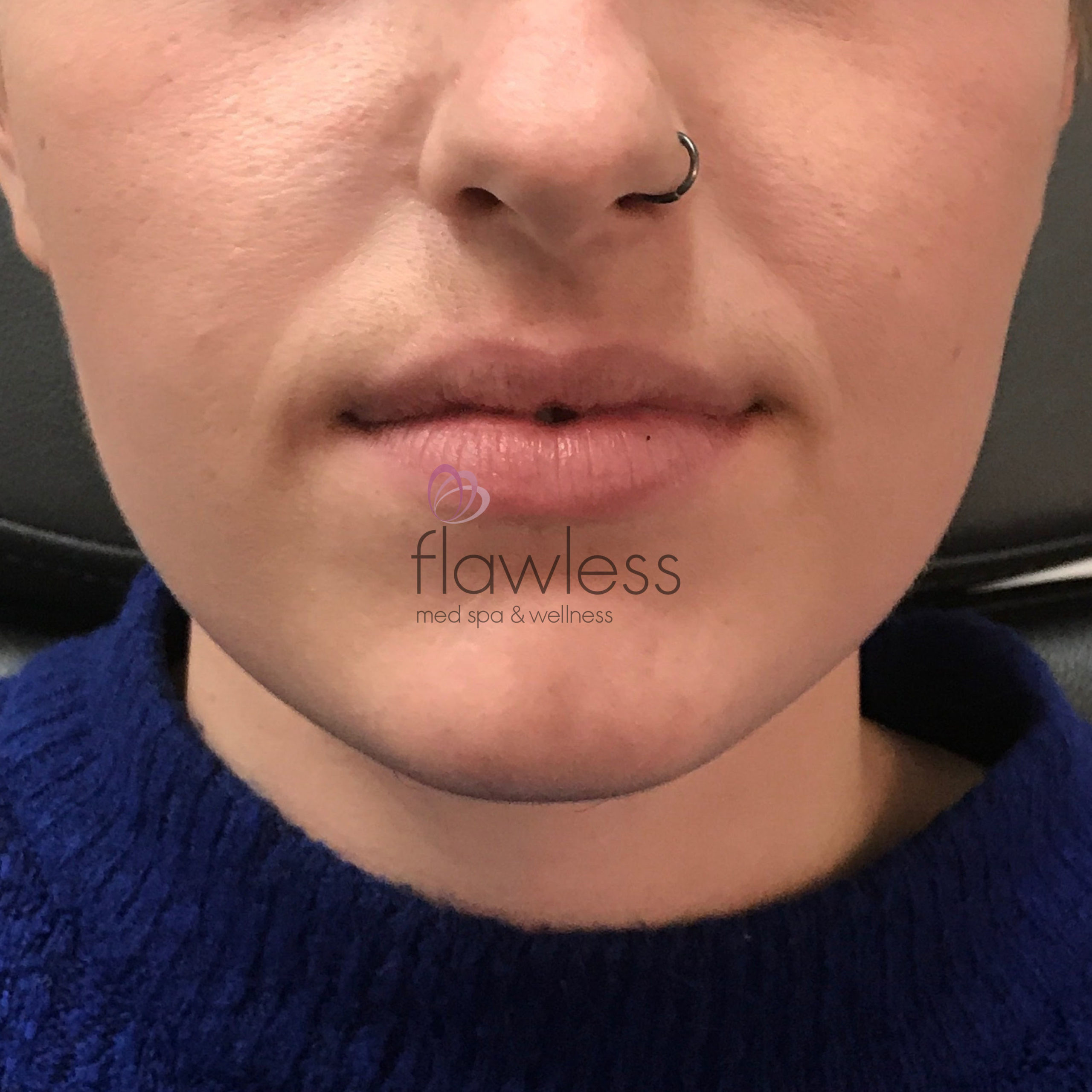 Lip Filler Before & After Gallery - Patient 58193382 - Image 1