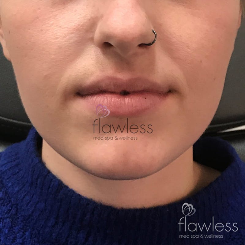 Lip Filler Before & After Gallery - Patient 58193382 - Image 1