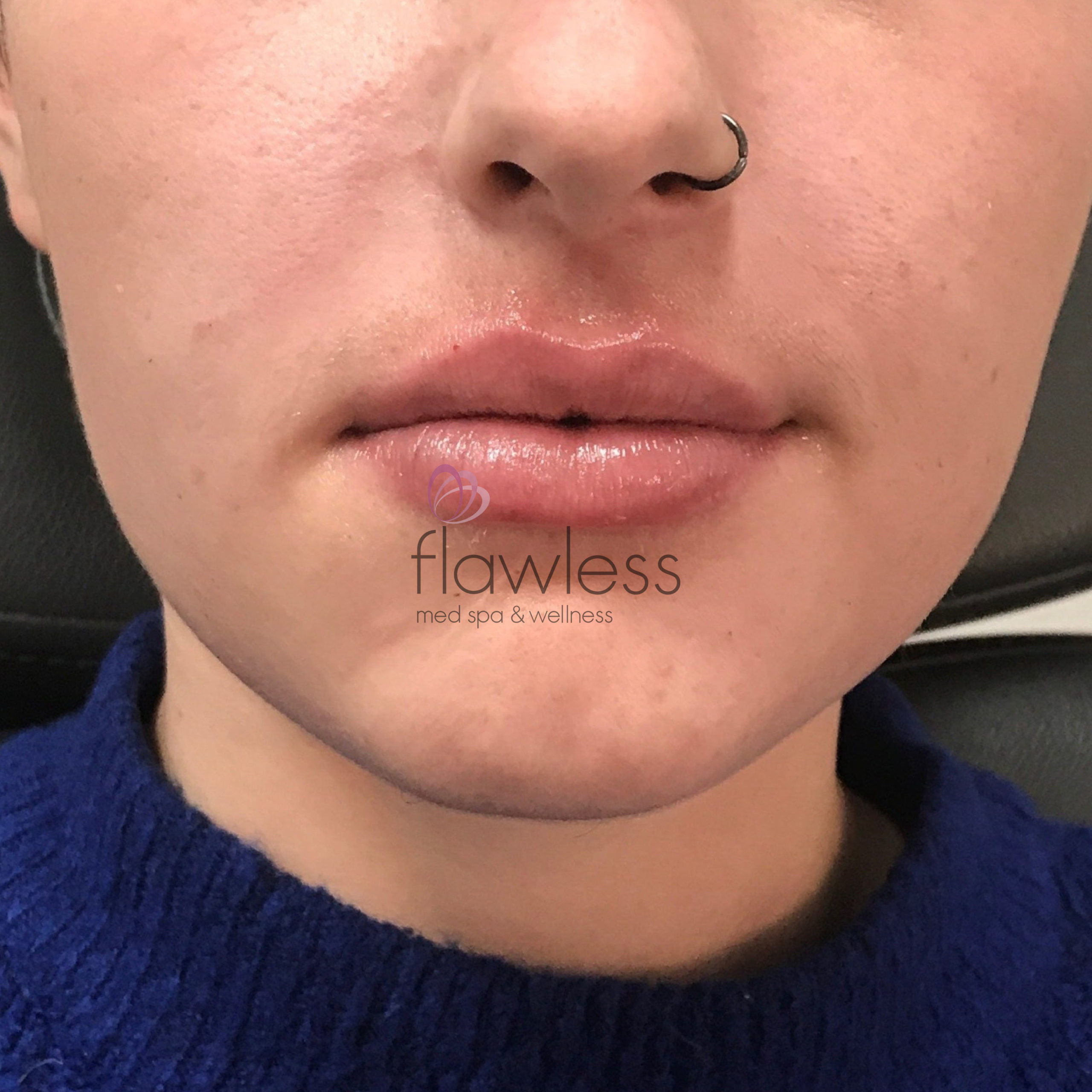Lip Filler Before & After Gallery - Patient 58193382 - Image 2