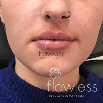 Lip Filler Before & After Gallery - Patient 58193382 - Image 2