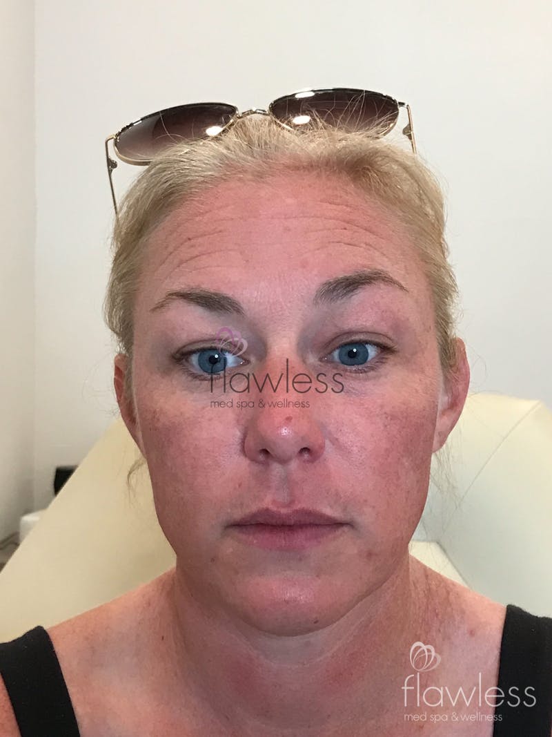 Melasma Before & After Gallery - Patient 58193381 - Image 3