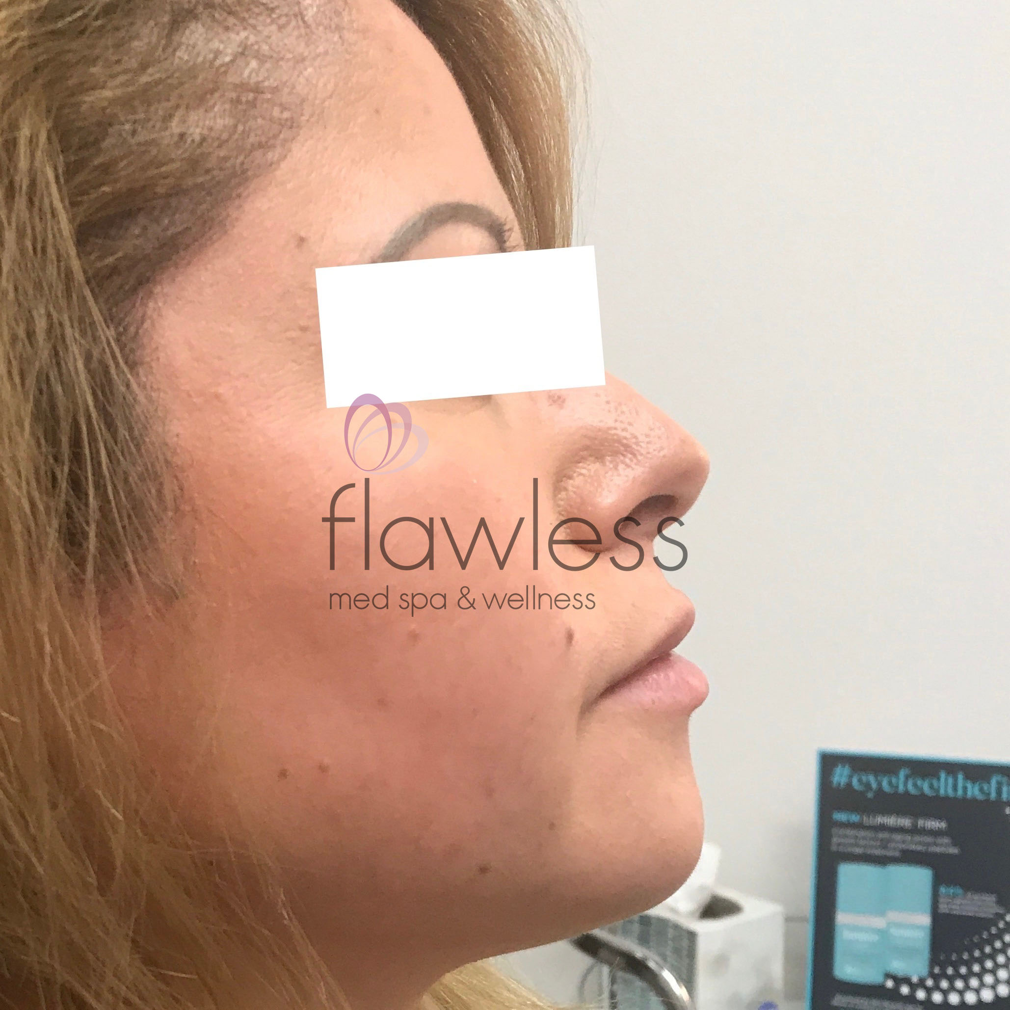 Lip Filler Before & After Gallery - Patient 58193384 - Image 1