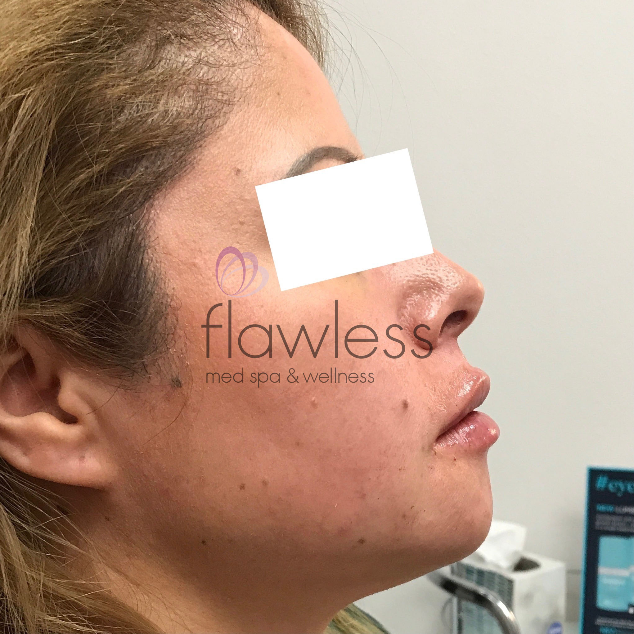 Lip Filler Before & After Gallery - Patient 58193384 - Image 2