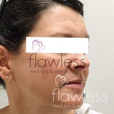Melasma Before & After Gallery - Patient 58193387 - Image 1