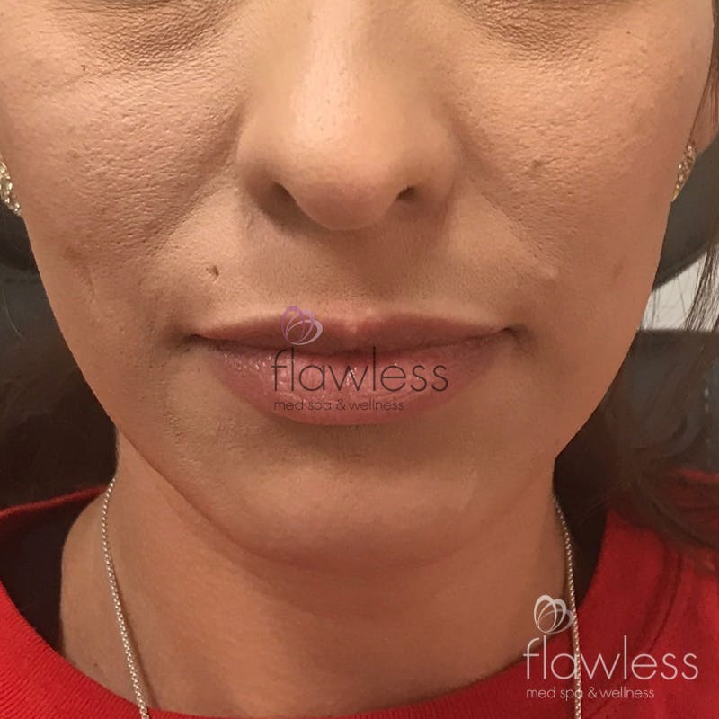 Lip Filler Before & After Gallery - Patient 58193388 - Image 1