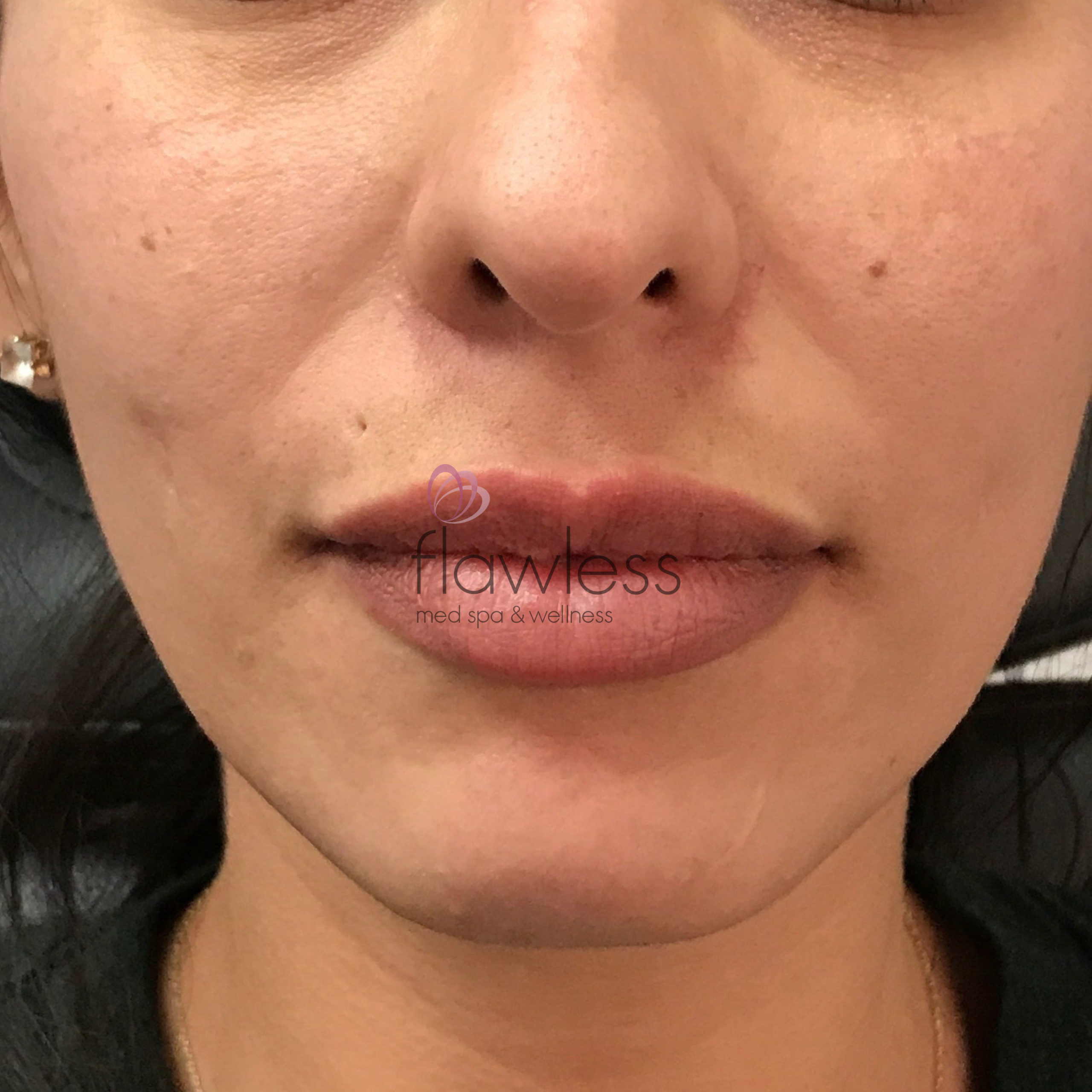 Lip Filler Before & After Gallery - Patient 58193388 - Image 2