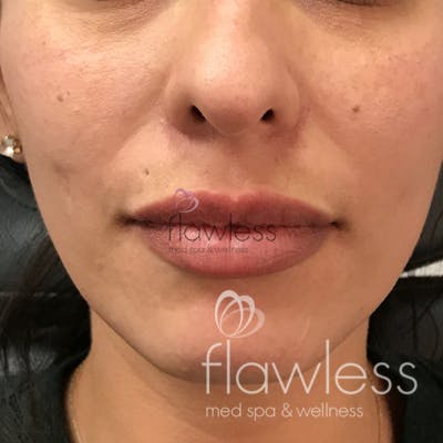 Lip Filler Before & After Gallery - Patient 58193388 - Image 2