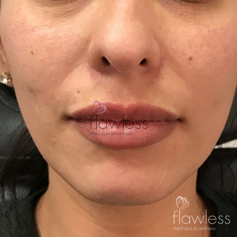 Lip Filler Before & After Gallery - Patient 58193388 - Image 2