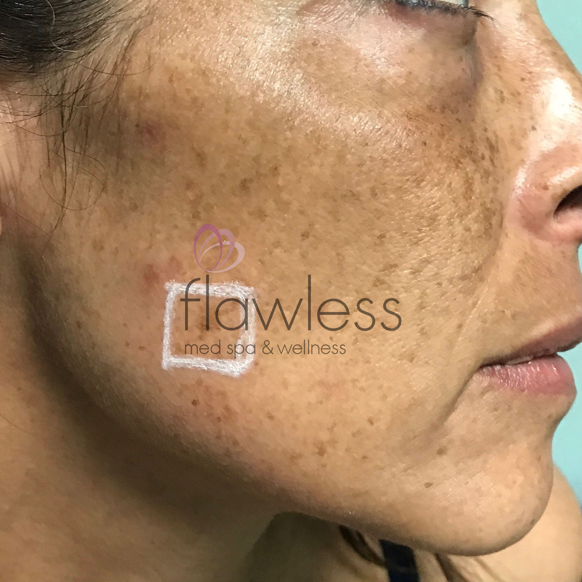 Melasma Before & After Gallery - Patient 58193390 - Image 1