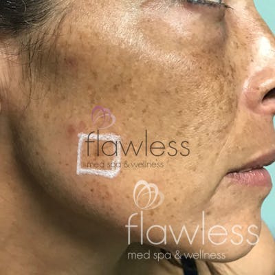 Melasma Before & After Gallery - Patient 58193390 - Image 1