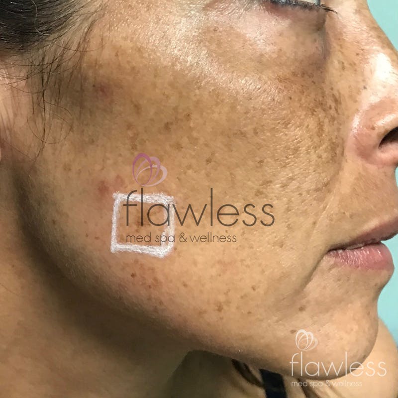 Melasma Before & After Gallery - Patient 58193390 - Image 1