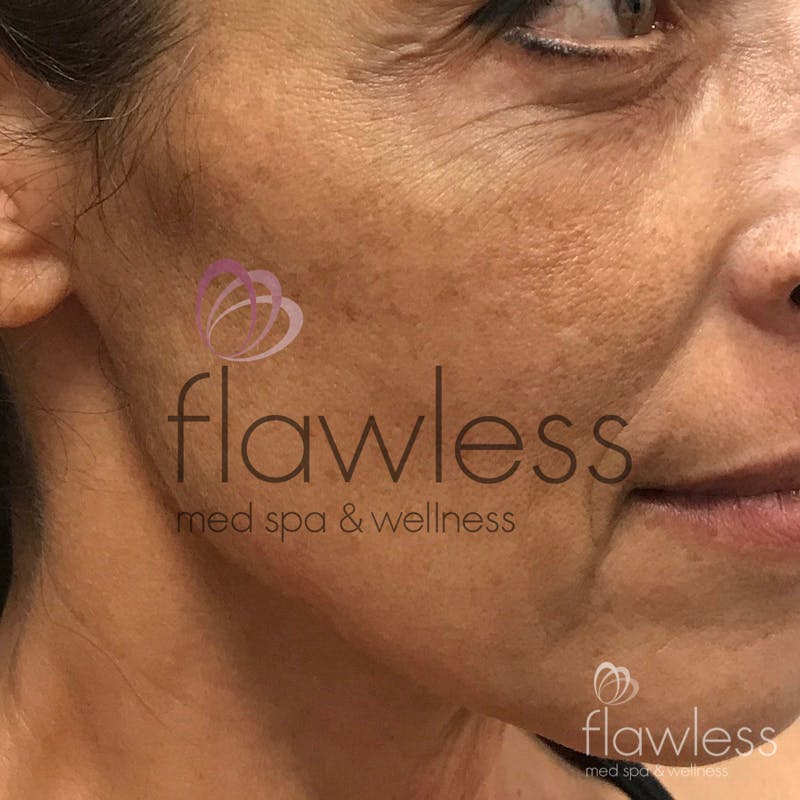 Melasma Before & After Gallery - Patient 58193390 - Image 2