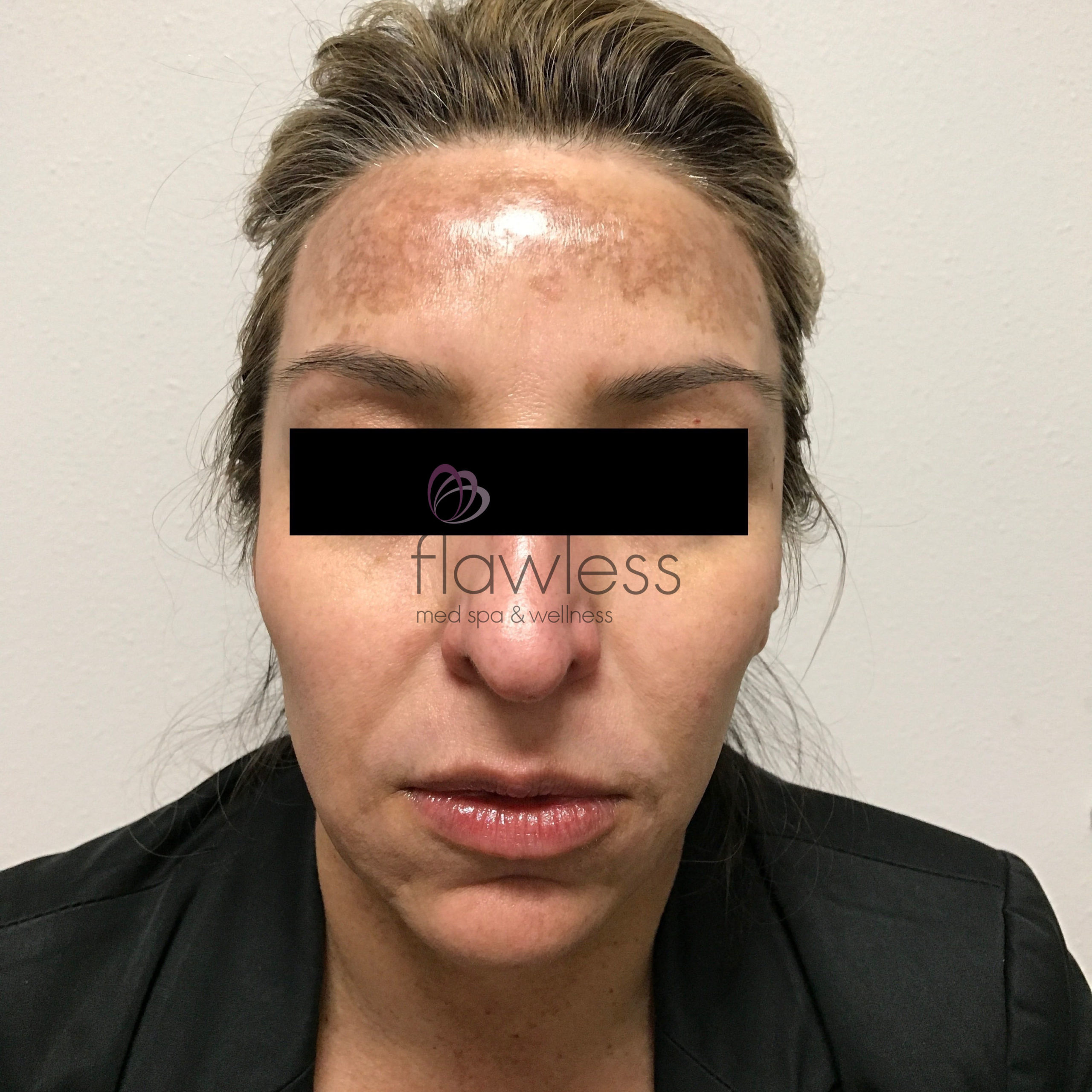 Melasma Before & After Gallery - Patient 58193393 - Image 1