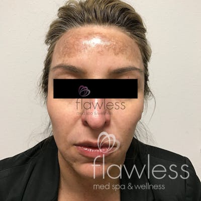 Melasma Before & After Gallery - Patient 58193393 - Image 1
