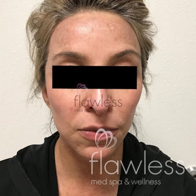 Melasma Before & After Gallery - Patient 58193393 - Image 2