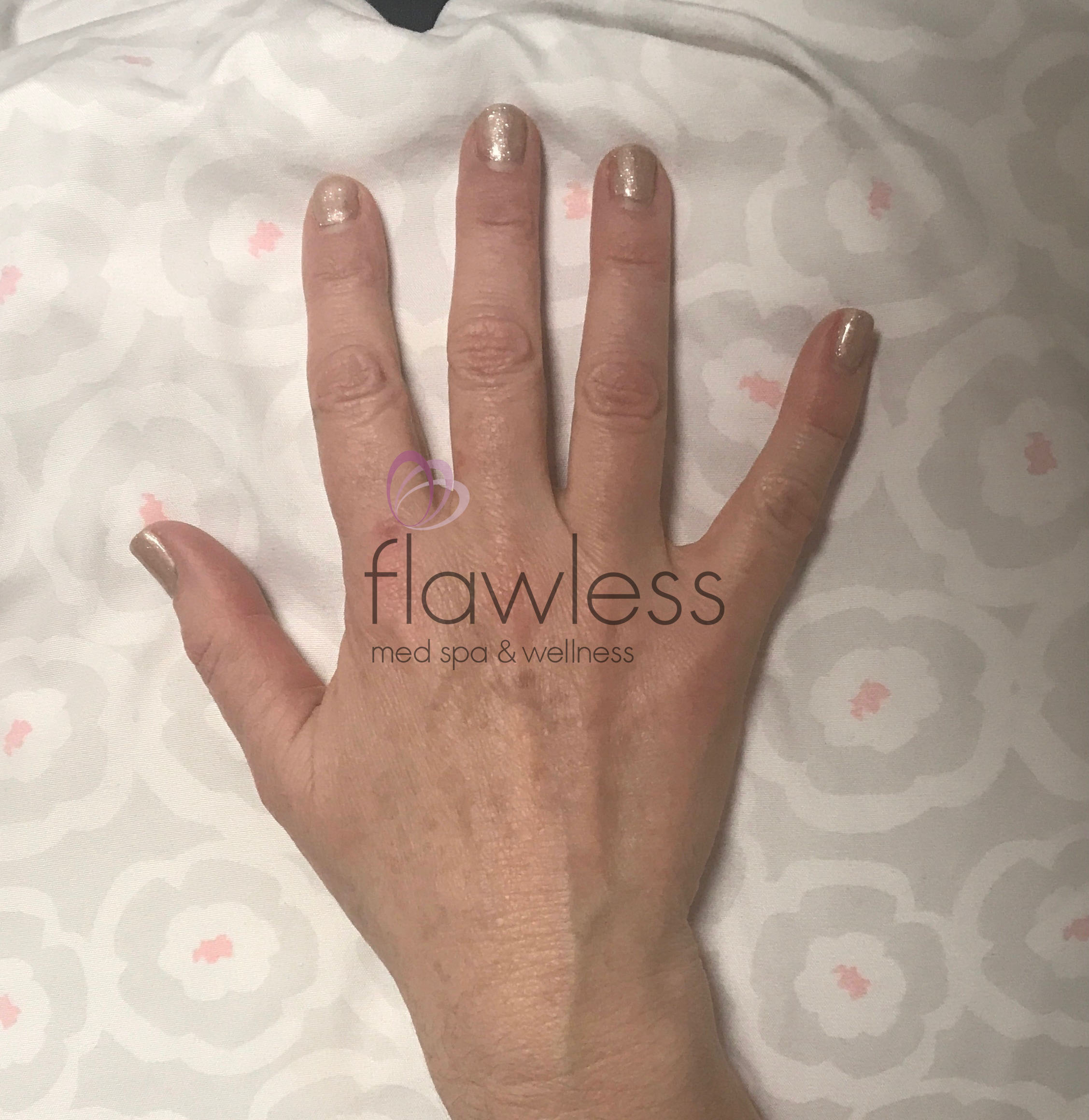 Pico Laser Skin Rejuvenation Before & After Gallery - Patient 58193394 - Image 2