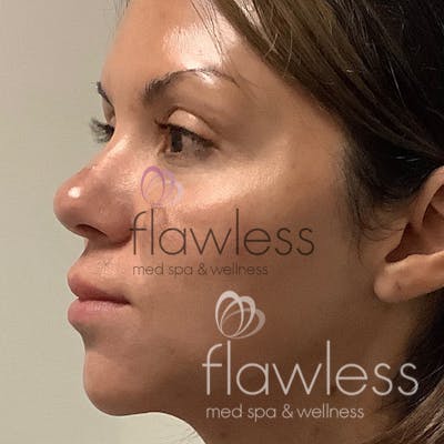 Melasma Before & After Gallery - Patient 58193396 - Image 1