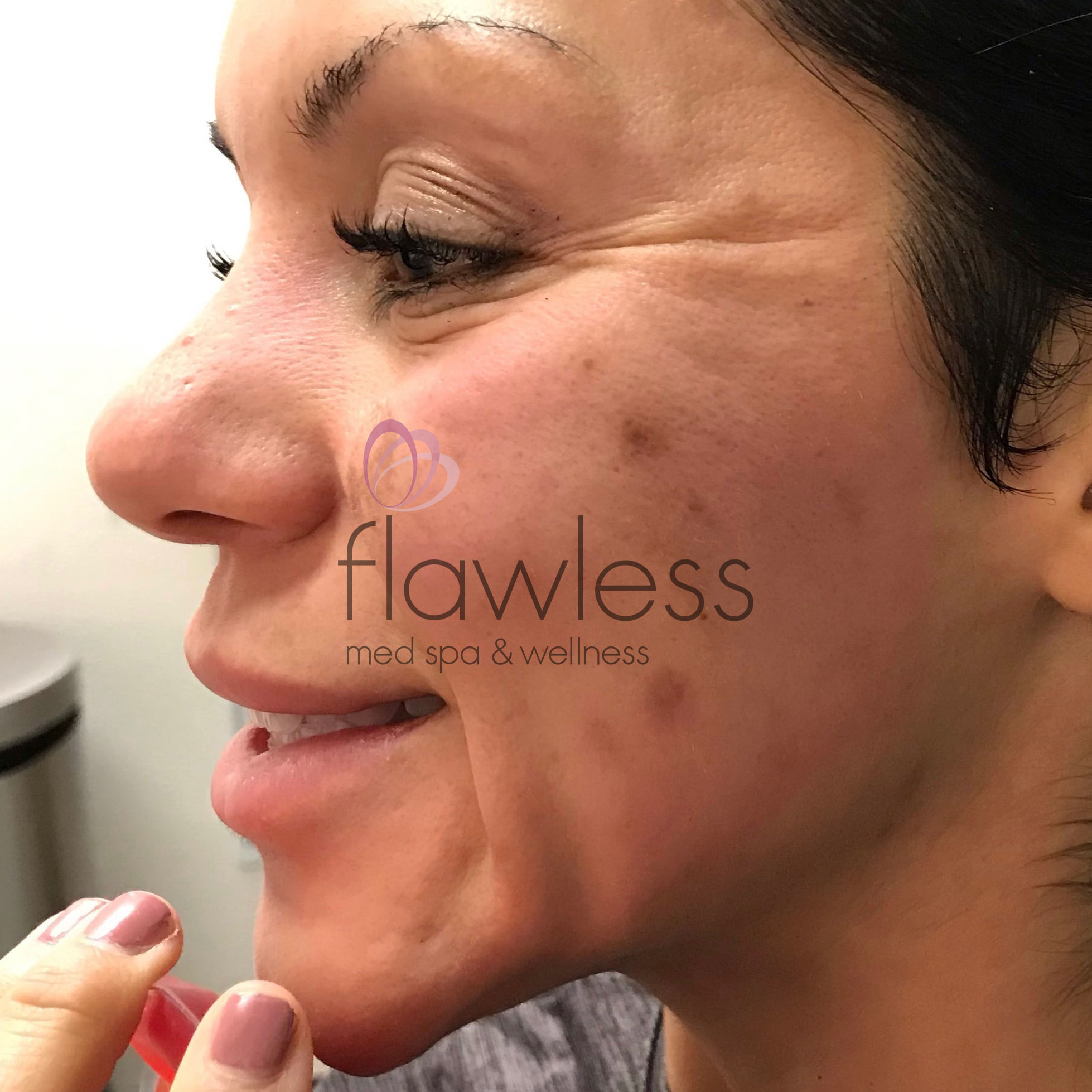 Melasma Before & After Gallery - Patient 58193396 - Image 2