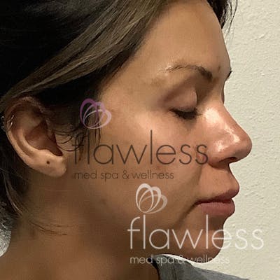 Melasma Before & After Gallery - Patient 58193399 - Image 1