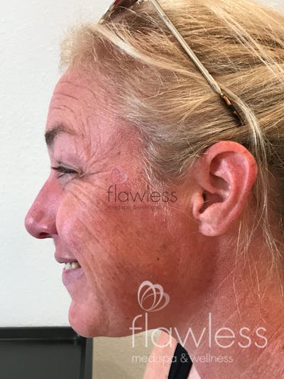 Pico Laser Skin Rejuvenation Before & After Gallery - Patient 58193409 - Image 1