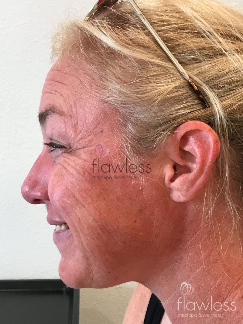 Pico Laser Skin Rejuvenation Before & After Gallery - Patient 58193409 - Image 1