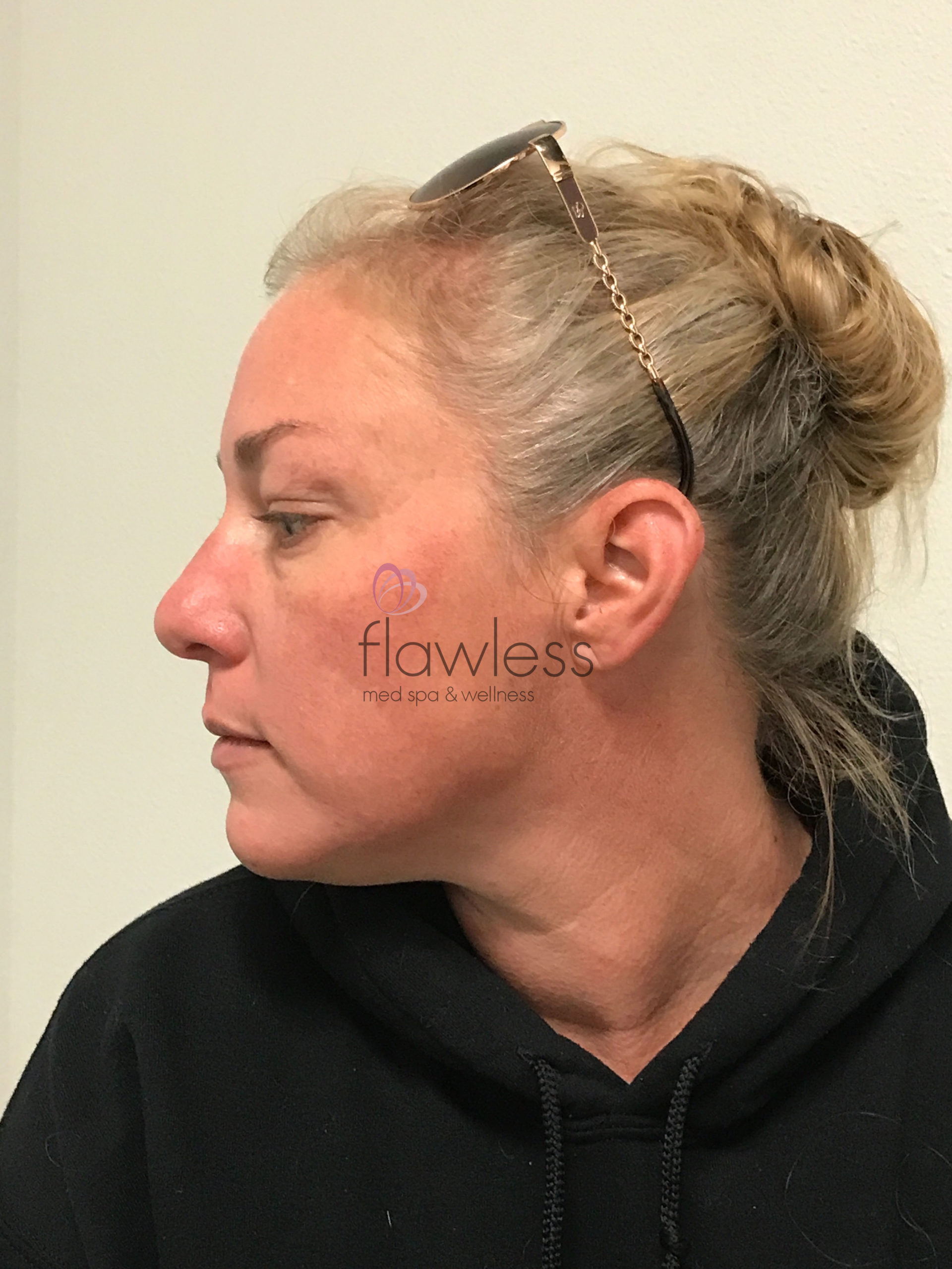 Pico Laser Skin Rejuvenation Before & After Gallery - Patient 58193409 - Image 2