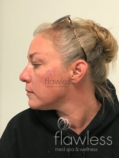 Pico Laser Skin Rejuvenation Before & After Gallery - Patient 58193409 - Image 2