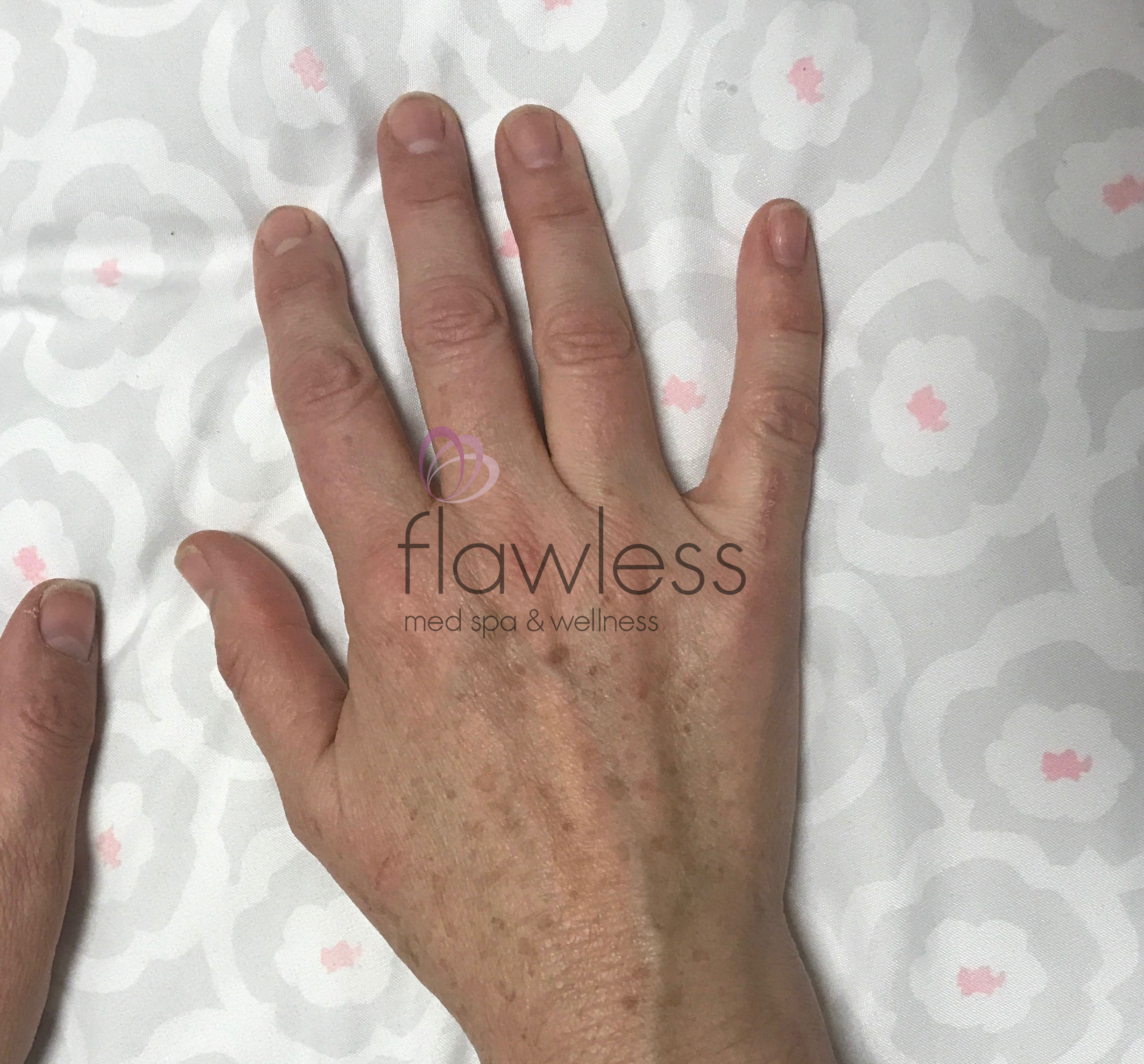 Age Spots - Body Before & After Gallery - Patient 58193410 - Image 1