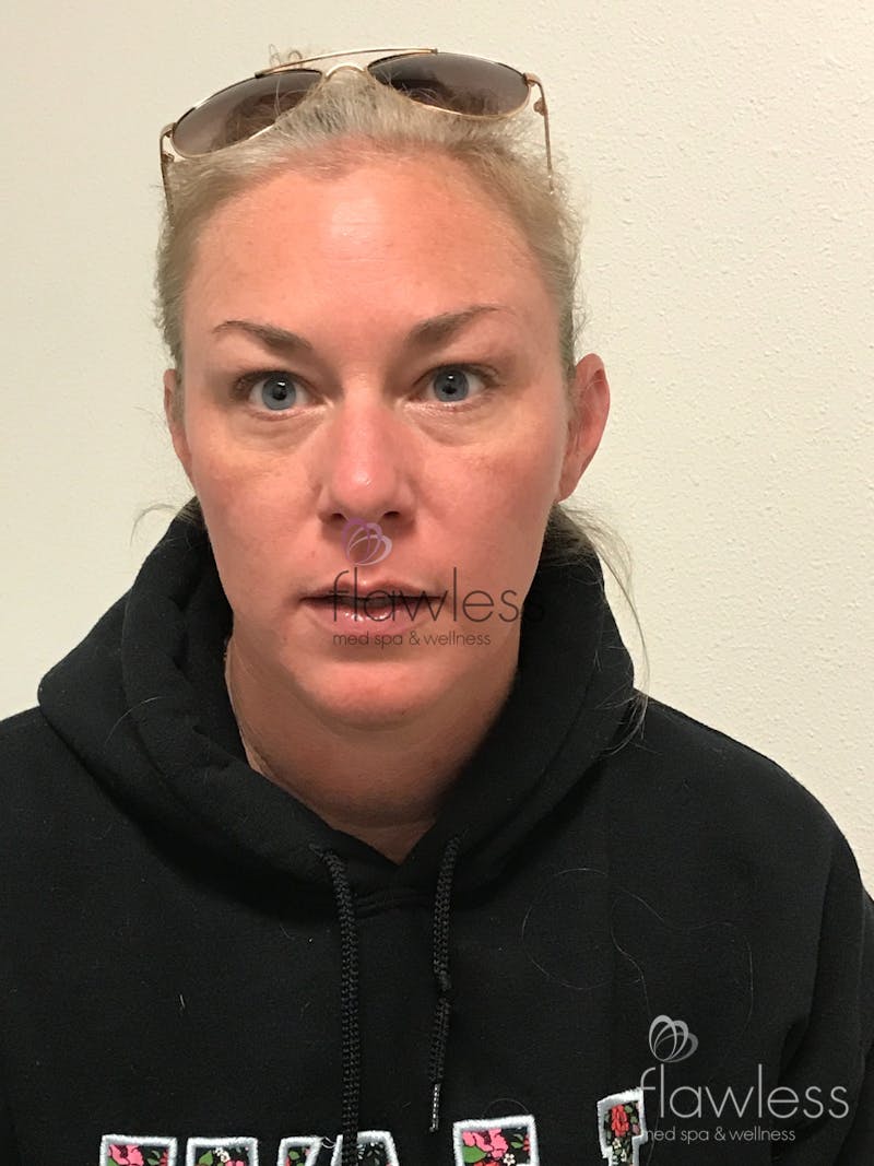 Patient 58193409 Pico Laser Skin Rejuvenation Before & After Photos