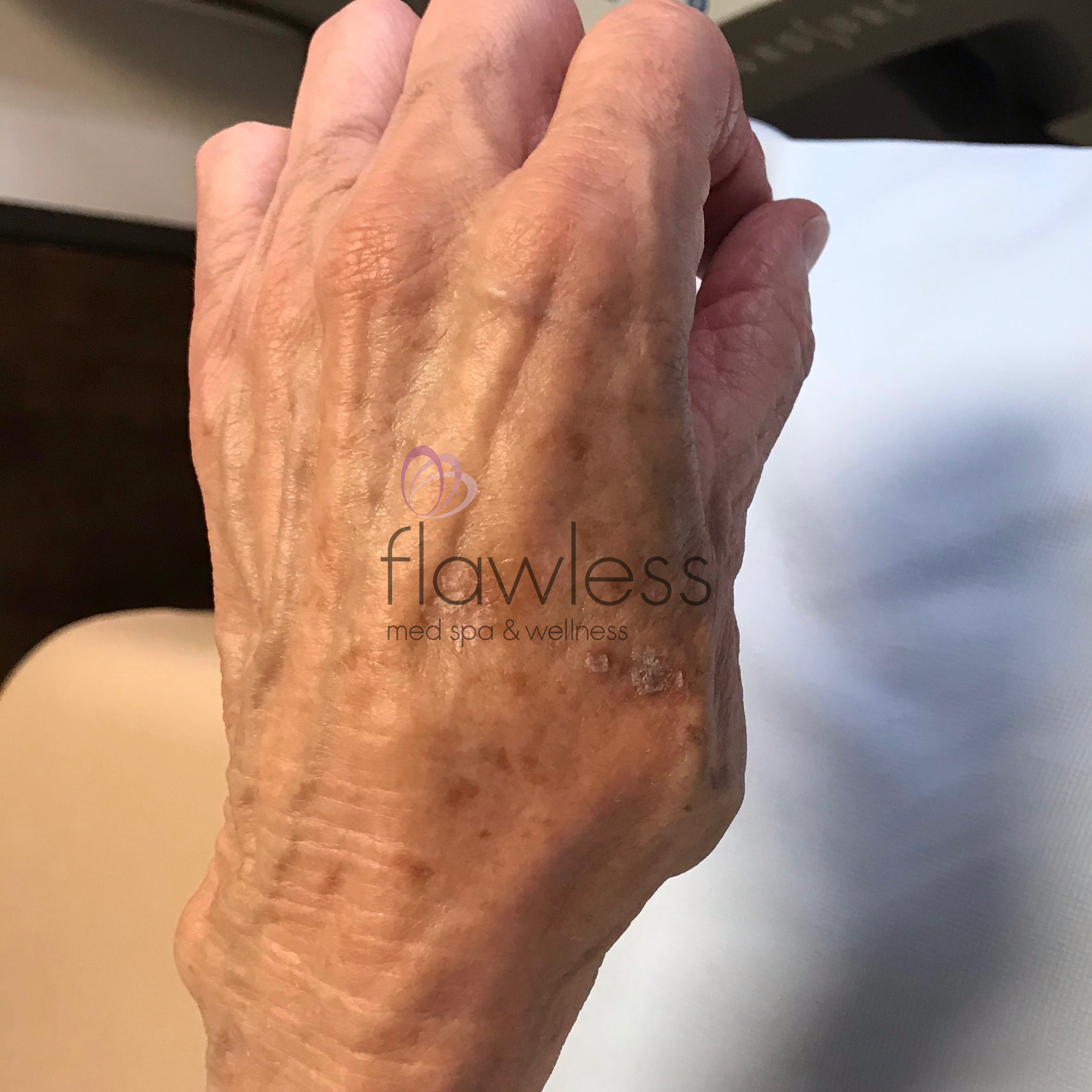 Age Spots - Body Before & After Gallery - Patient 58193414 - Image 1